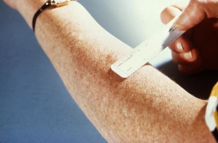 tb test